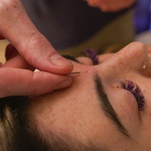 Acupuncture